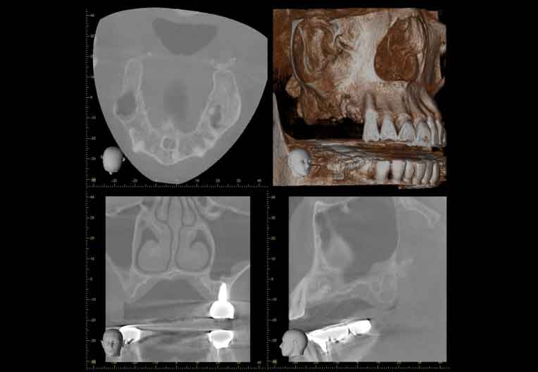 歯科用CT撮影