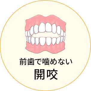 前歯で噛めない 空隙歯列