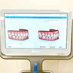 矯正中に同時にホワイトニングもできます
