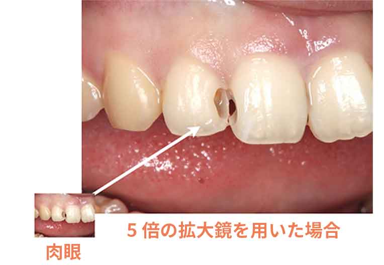虫歯は初期には症状を出さず、再発しやすい病気
