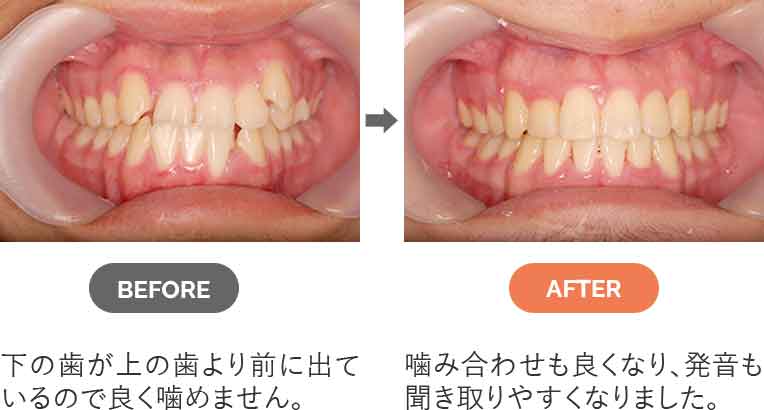 反対咬合（受け口）