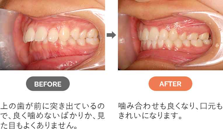 上顎前突、出っ歯