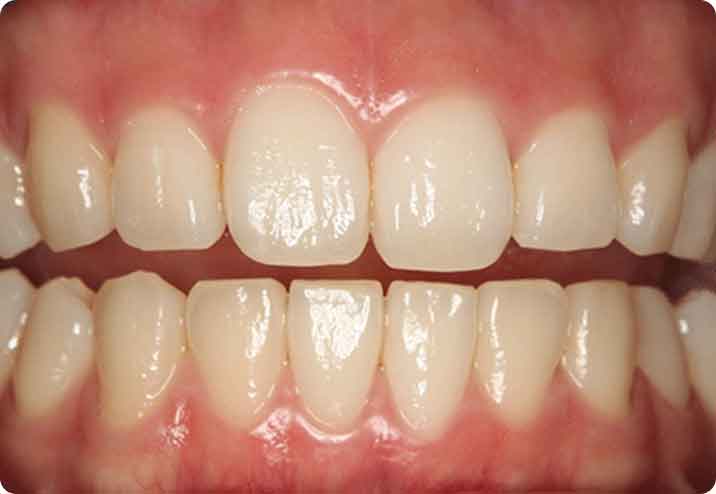 歯周病治療(歯槽膿漏の治療)