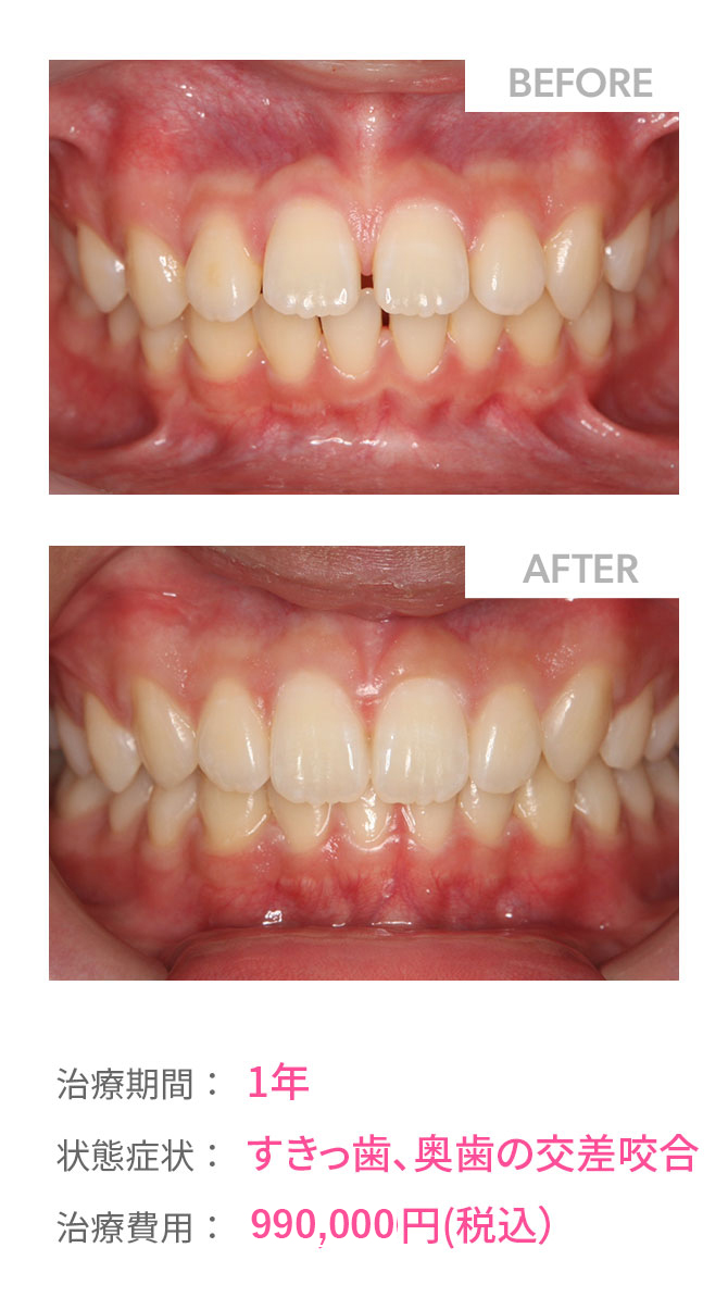 インビザライン症例