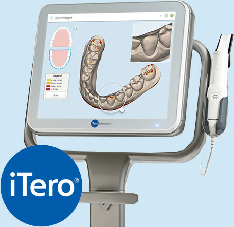 iTeroによる歯型スキャンサービス